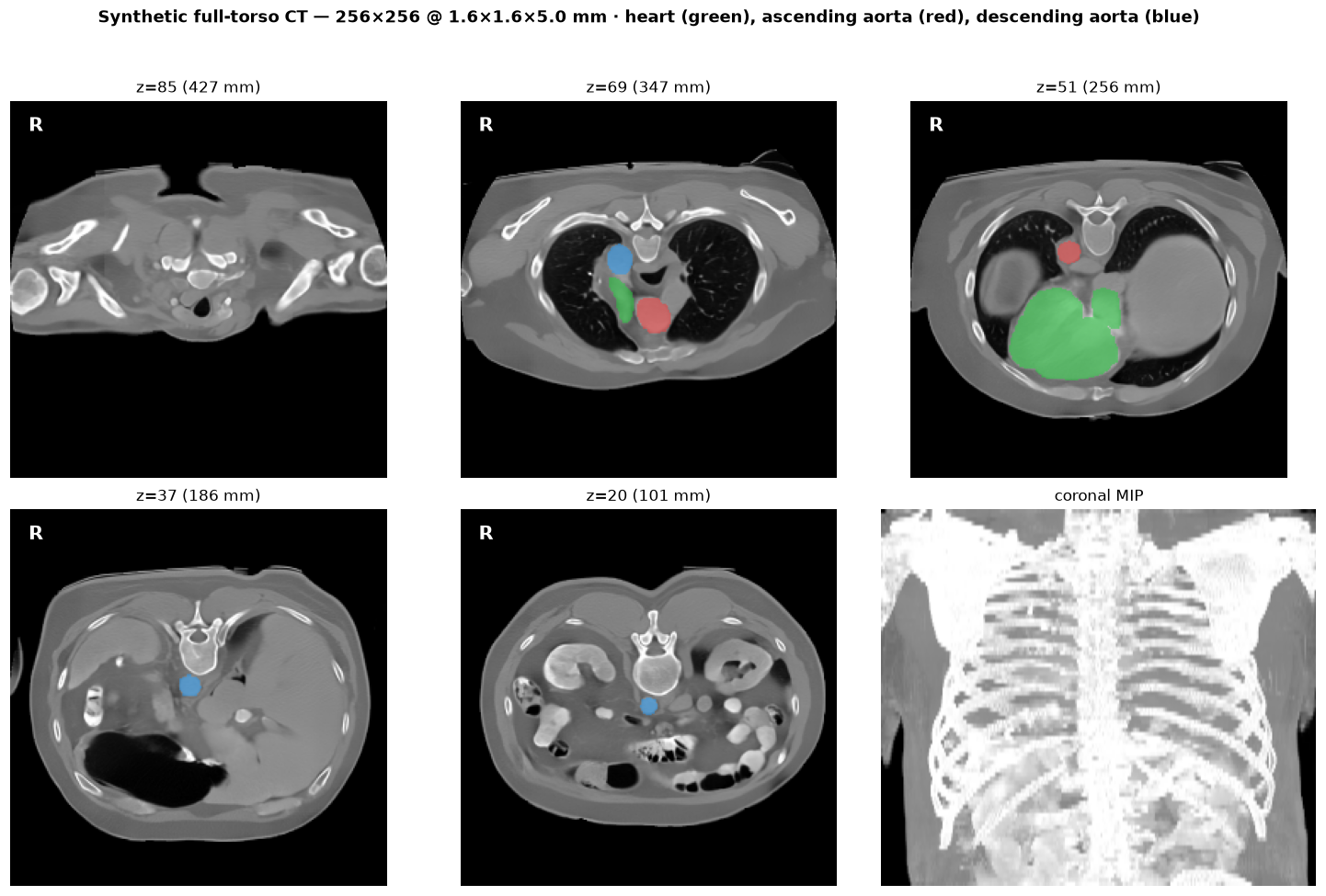 synthetic heart CT
