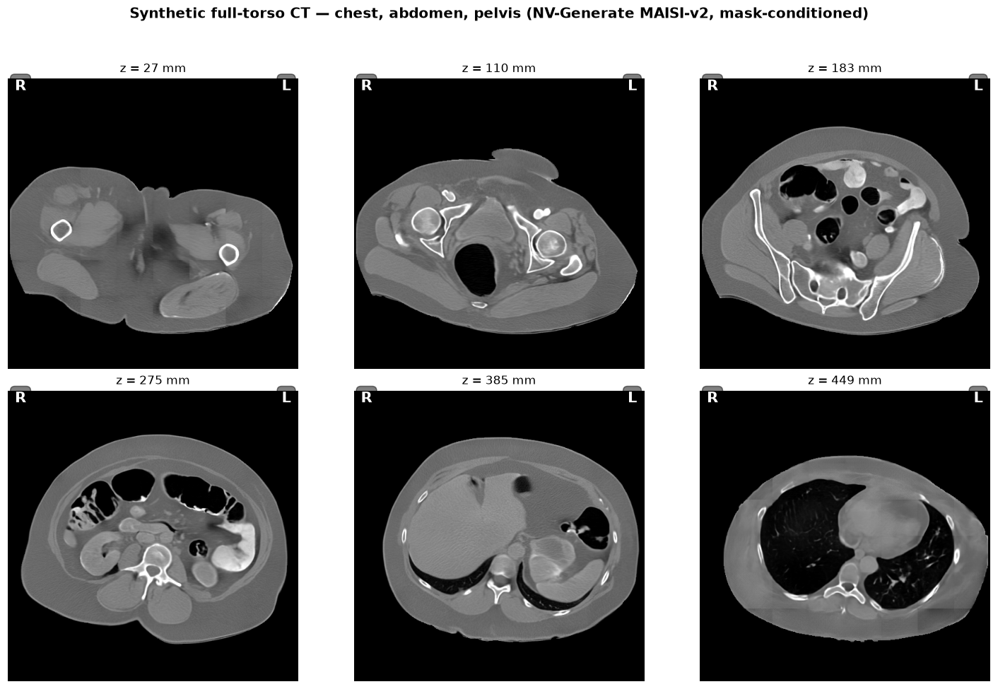 synthetic heart CT