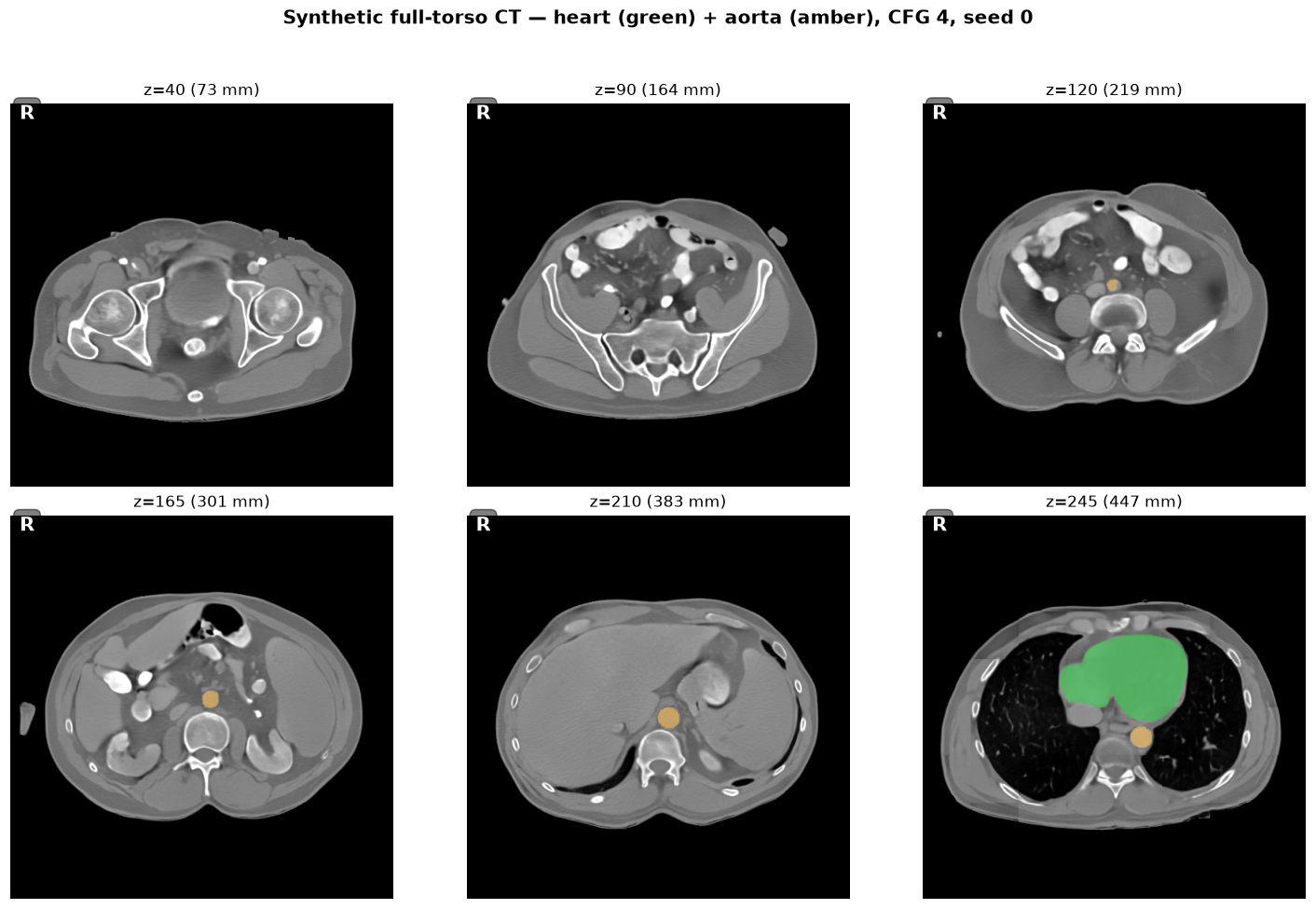 synthetic heart CT